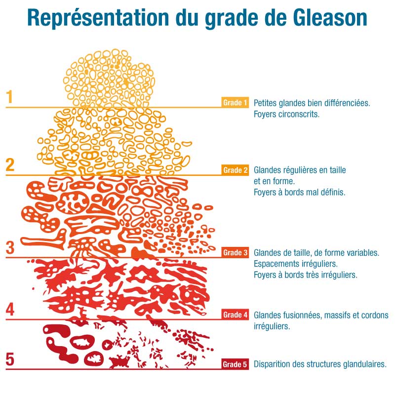 C'EST QUOI LE SCORE DE GLEASON
